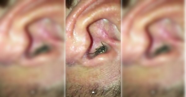Viral Video of Spider Crawling Out of Man’s Ear Is Actually Fake