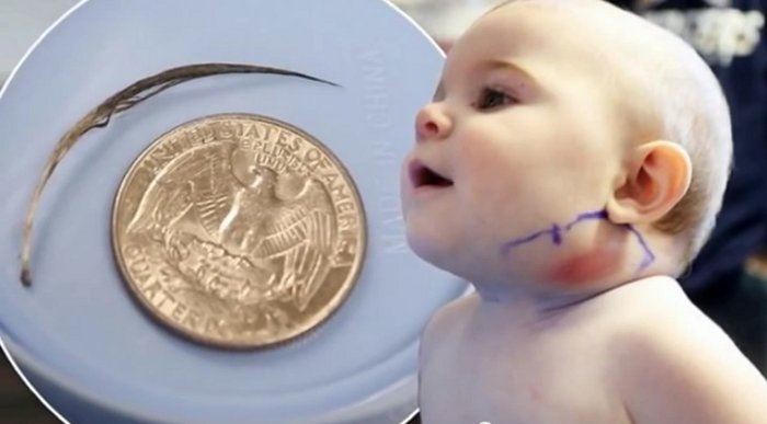 Parents Discover Feather from Their Baby’s Swollen Jaw