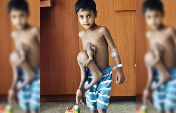 Boy With Eight Arms and Legs Undergoes Surgery to Remove Extra Limbs