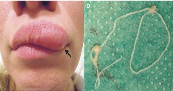 Mysterious Lump Moves across Woman’s Face, Turns Out to be a Worm